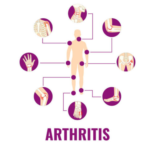 Various Type of Arthlitis